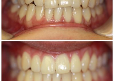 Inmam Aligners