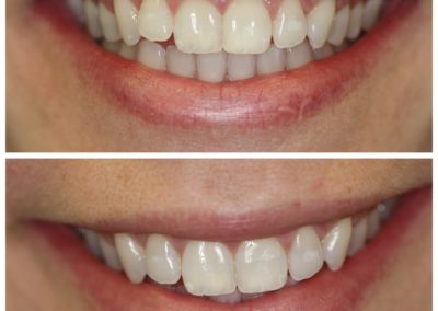 Inmam Aligners